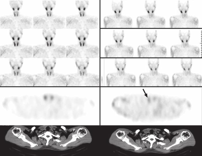 55 PTGs detected in each delayed phase study, indicating that early and delayed phase SPECT/CT can depict similar numbers of PTGs (t = 1.721, p > 0.05).