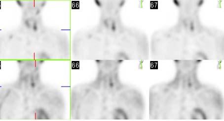 Double Adenoma SPECT vs SPECT CT with