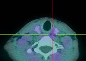 Results SPECT SPECT/CT lateralization