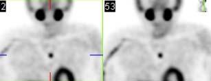 (dual phase) and delayed SPECT/CT Surgical