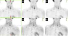 Double Adenoma SPECT vs SPECT CT with Nodular Goitre 33 pts 18 planar + SPECT 13 planar + SPECT/CT Compared pre-op imaging