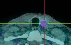 56 mins 38mins SPECT/CT better quadrant localization MGD: identified on SPECT/CT only Pata et al 2010 Thyroid 20: