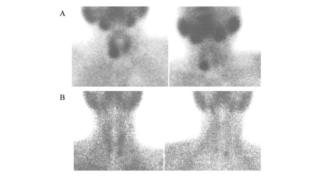 Kandeel et al Figure 1: Dual phase Tc MIBI scan at 20 min (early phase) on the left and at 2 hours (delayed phase) on the right in two patients with uremic hyperparathyroidism: (A) shows right lower