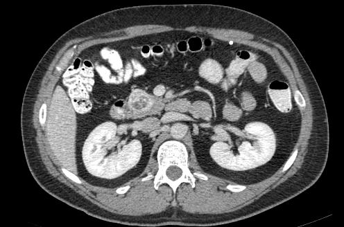 A 39 year old male with suspected pancreatic