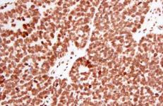 Stains for Tumor Classification p53 p16 WT1 HMGA2 P53 Mutations
