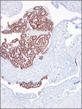 p53 p16 CASE 1 Diagnosis Pelvic High Grade Serous Carcinoma, Possibly Originating in the