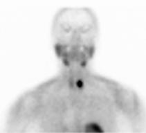 Tc-99m Sestamibi Dual-Phase Imaging Planar Imaging Early Delayed Uptake by thyroid & parathyroid Delayed