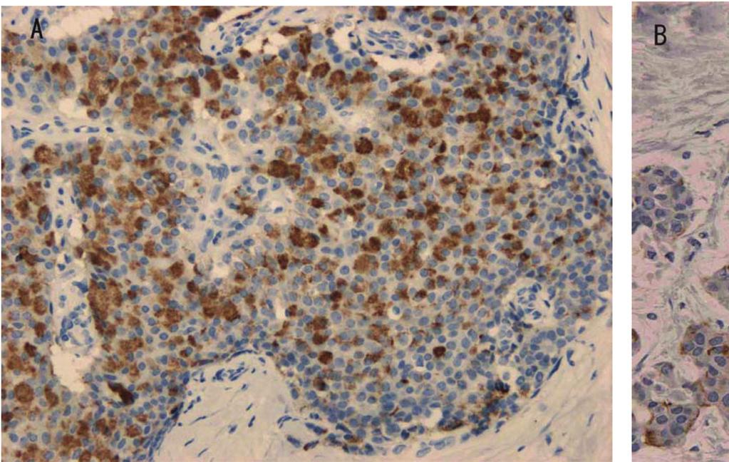 159 Cytoplasmic HER2 staining and neuroendocrine features Figure 1 : Immunohistochemistry using a HercepTest staining kit showed a