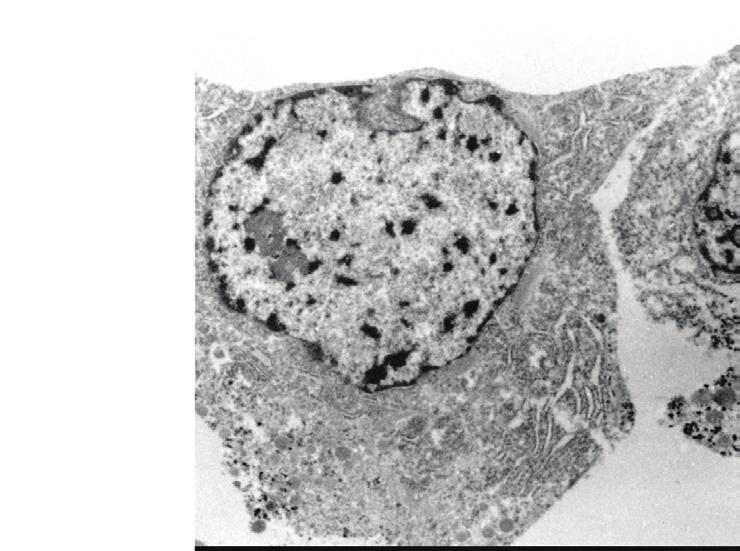 Cytoplasmic HER2 staining and neuroendocrine features 161 Figure 5 : Immunoelectron microscopy.