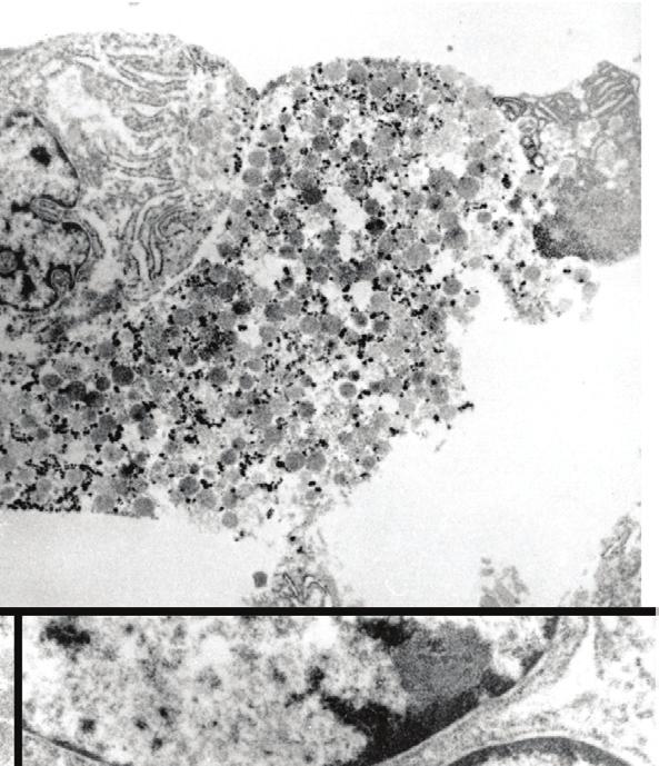 corresponded to the immunohistochemical staining pattern of HER2 and neuroendocrine markers.