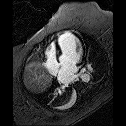 Patient EF: post-contrast MRI showing