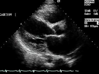 Parasternal long axis Echocardiographic findings