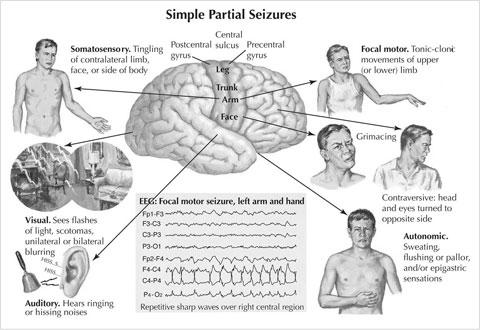 y Can seizures result in harm to patient y Driving, or any activity where sudden loss of consciousness may prove problematic Epilepsy vs.