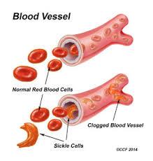 Sickle Cell Disease SCD is characterized by recurrent episodes of