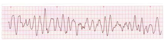 Causes of Cardiac Arrest Ventricular Fibrillation & pulseless V-TACH Not 100% understood