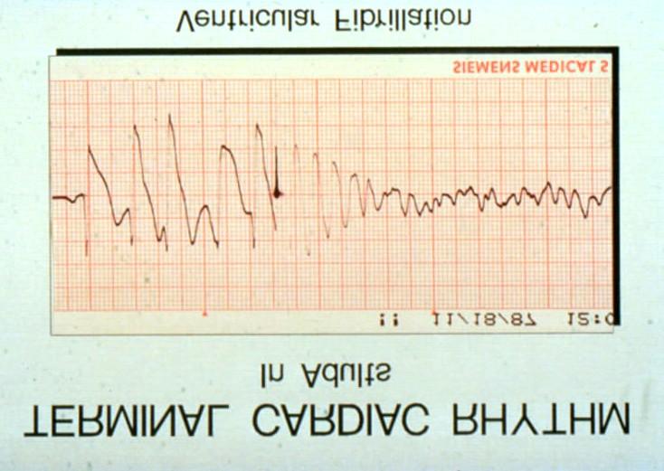 Three Phases of Adult VF Cardiac Arrest Electrical Phase (Early Defibrillation Critical) Hemodynamic