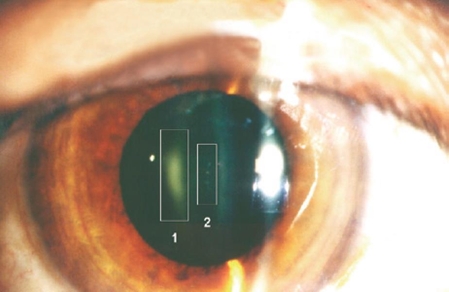 Harmful effects of ionizing radiation Radio-induced crystalline lens opacity in an interventional radiologist submitted to high levels of radiation using an X-ray tube above the table.
