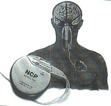 Vagus Nerve Stimulator Device implanted just under the skin in the chest with wires that attach to the vagus nerve in the neck Delivers intermittent electrical stimulation to the vagus nerve in the