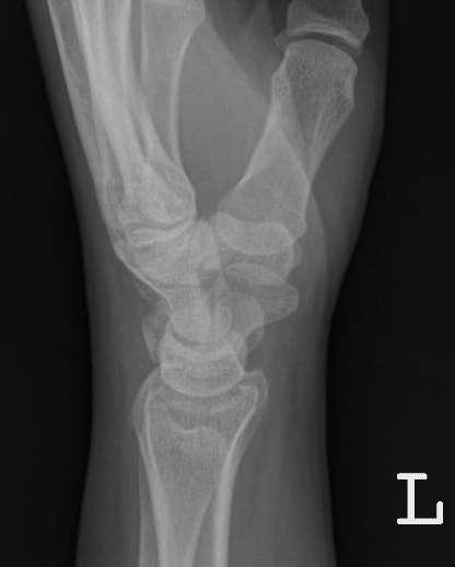 PA wrist radiographs showing a normal wrist (left) and a wrist with scapholunate dissociation, (right) confirmed by the wide gap between the lunate and the scaphoid (left and center arrows) and a
