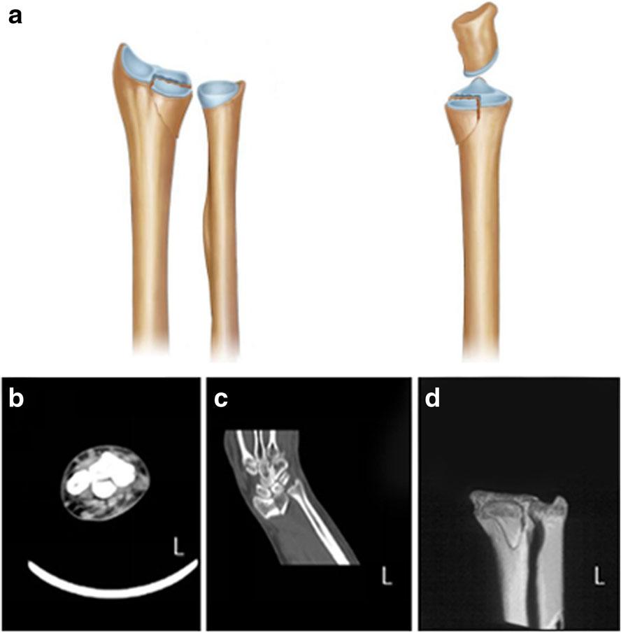 Zhang et al. Journal of Orthopaedic Surgery and Research (2016) 11:124 Page 3 of 5 Fig. 3 Volar depression fracture.