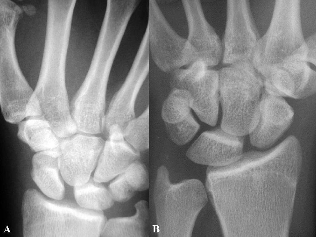 Radial wrist extensors as a dynamic stabilizers of scapholunate complex 455 patients had radiological tests in one stress view (clenched fist) carried out.