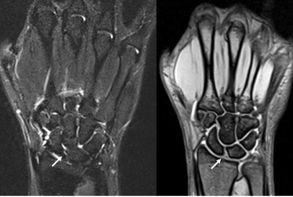 Static scapholunate instability complete scapholunate ligament injury (gap 5 mm); A without rotary subluxation of the scaphoid, B with palmar subluxation of the scaphoid lateral view and indicating