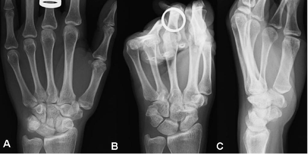 extension of the scaphoid with no clear gap between the scaphoid and lunate, C lateral view (scaphoid radial angle 61º), D-F left hand, D healthy wrist in PA view in neutral position, E healthy wrist