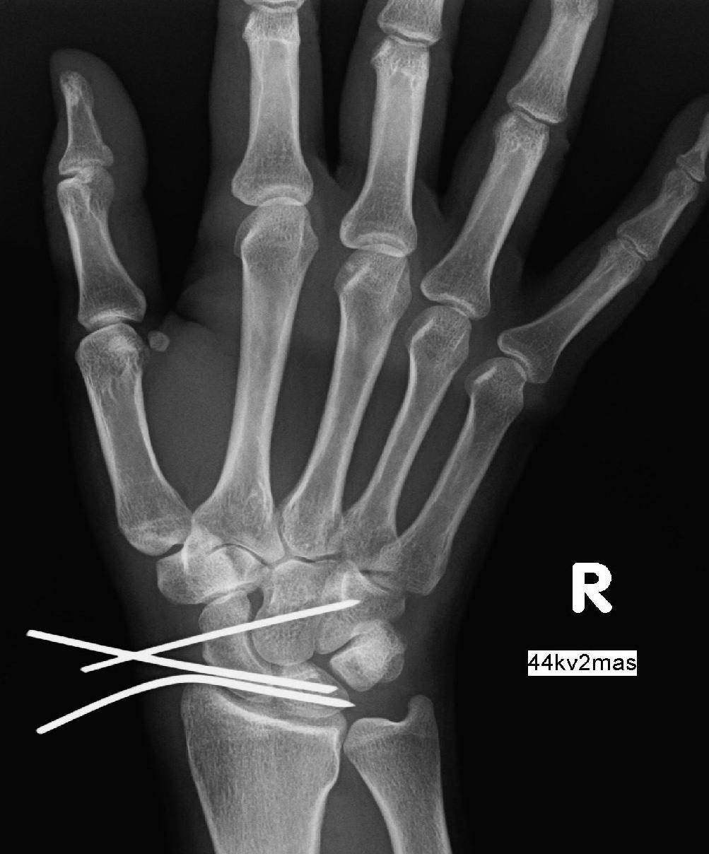 ligament, not allowing for distal manipulation by means of the probe.