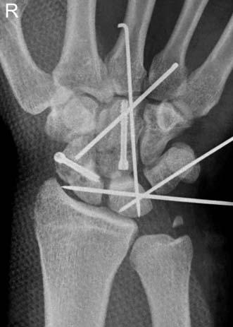 When he presented to the emergency department, there was severe deformity on his right hand with the protrusion of distal radius which was disarticulated from carpal bones and penetrated skin to
