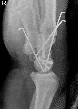 A proximal pole of capitate showed 22 translation (Fig. 1A, B). Because it was an open fracture dislocation, he underwent the emergent surgery.