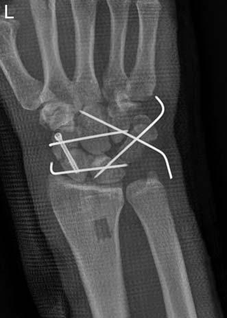 (C, D) Postoperative X-ray image of the left wrist.