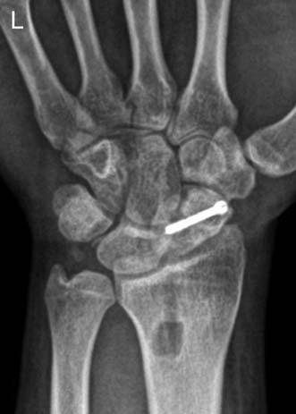We could find the early arthritic change of the mid-carpal joint.
