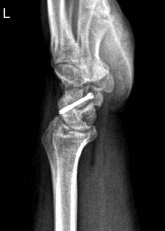 dislocation and 3 cases of bilateral scaphoid fractures associated with