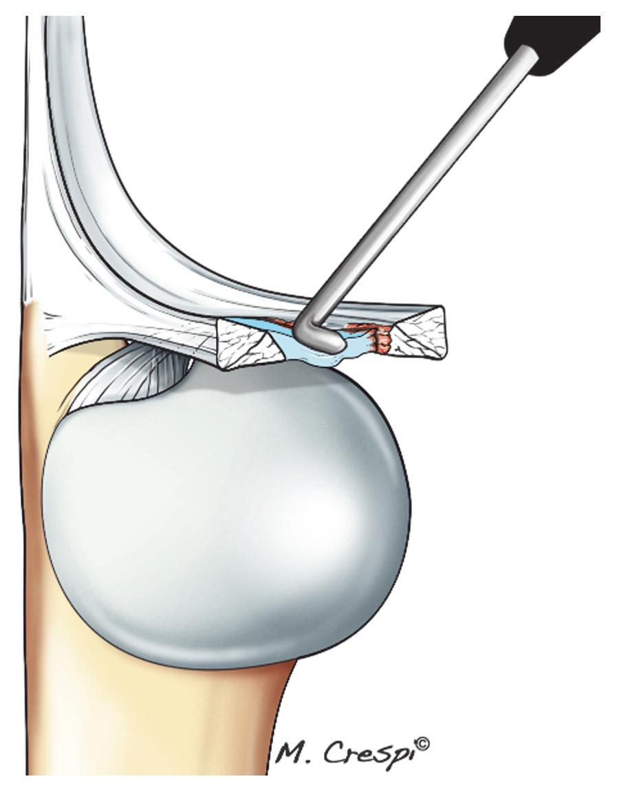ARUL, anterior radioulnar ligament; PRUL, posterior radioulnar ligament; S, superficial fibers; D, deep fibers; U, ulna; R, radius.