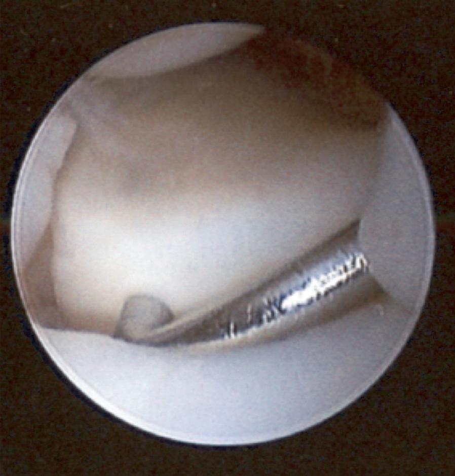 Chapter 13 Arthroscopic Lunotriquetral Arthrodesis and Head of the Hamate Resection Introduction Lunotriquetral arthrodesis is a controversial procedure but is sometimes proposed as a last resort for
