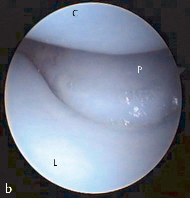 Operative Technique (Fontes) Fig. 13.2a, b Drawing (a) and arthroscopic view (b) of a Viegas type I wrist where the distal lunate is evenly rounded. C, capitate; H, hamate; L, lunate; P, triquetrum.