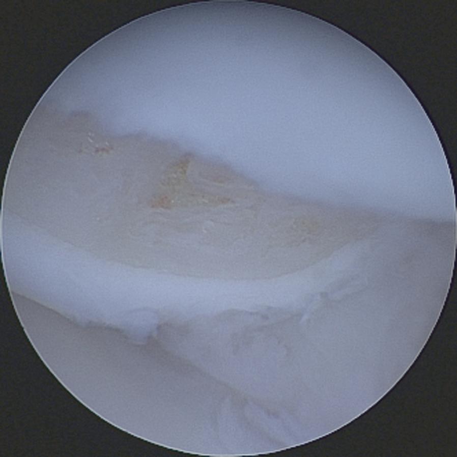 Chapter 13 Arthroscopic Lunotriquetral Arthrodesis and Head of the Hamate Resection Fig. 13.4 Drawing of impingement between the head of the hamate and medial lunate facet with lunotriquetral ligament rupture.