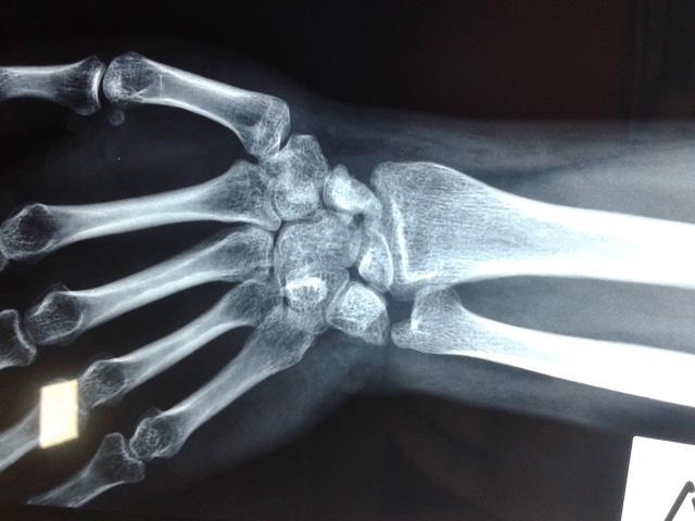 was slightly sclerotic in relation to the rest of the carpal bones.
