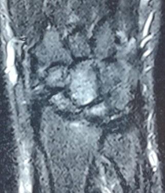 )335( THE RCHIVES OF ONE ND JOINT SURGERY. JS.MUMS.C.IR ISOLTED SCPHOID DISLOCTION Figure 7. The coronal STIR MRI image shows slightly high signal in scaphoid, lunate and capitate bone.