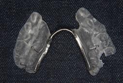 The Problem Without pre-surgical orthodontics, it is difficult to obtain a stable occlusion