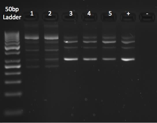 [646+1del];[=] 2: Twin 2 mild phenotype TAZ c.
