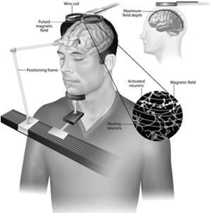 54 Brain Stimulation Electroconvulsive Therapy (ECT) ECT is used for severely depressed patients who do not respond to drugs.