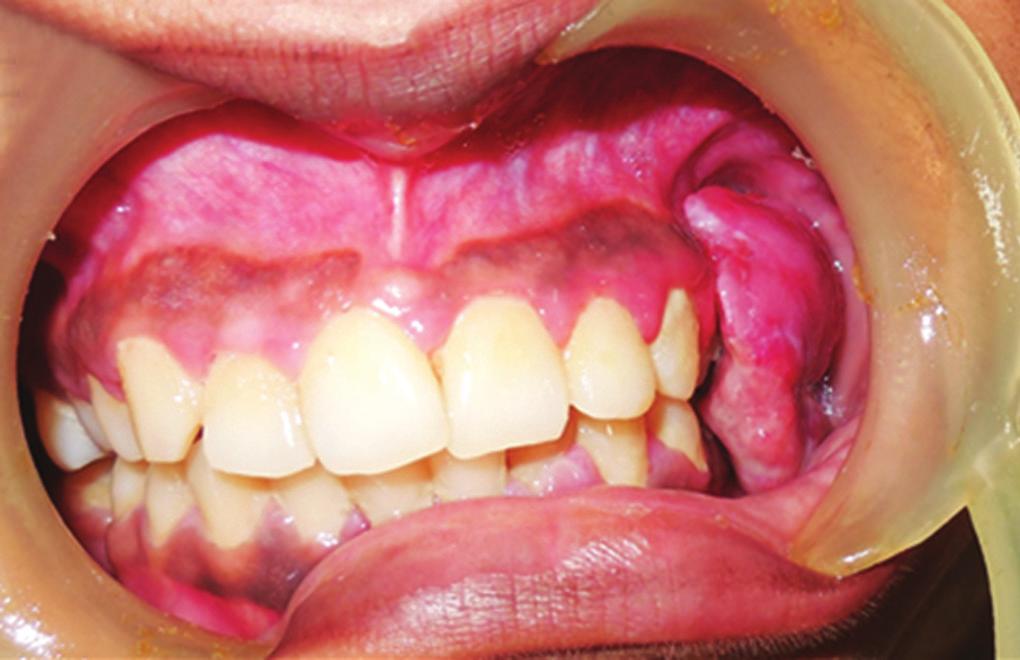 Differential diagnosis of peripheral giant cell granuloma and peripheral ossifying fibroma was considered. Initially, the lesion was treated by nonsurgical periodontal therapy.