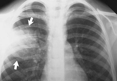 used to be called consumption S & S o Cough, sputum, hemoptysis, TB spread to organs leads to destruction of organs and organ systems DX of classic triad o Lung infiltrate, calcified node