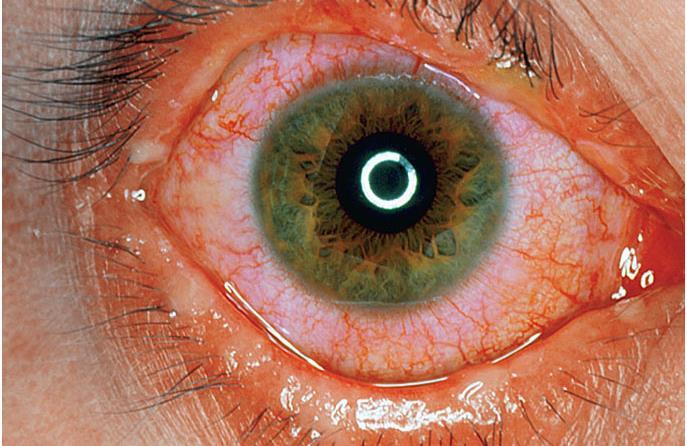 to bright light o Large amounts of pus Pathogenesis o Few details known about pathogenesis of bacterial conjunctivitis o Most likely from airborne respiratory droplets o Resist destruction by