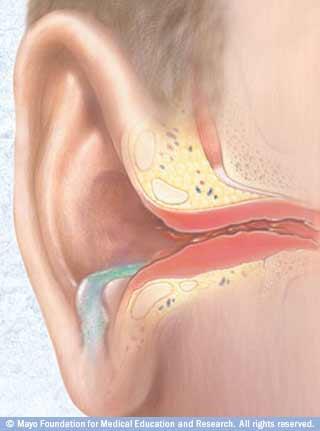 Otitis externa swimmers ear Is usually a mild annoyance Can be more severe in swimmers who swim daily Water trapped in the ear causes irritation, low grade infection and itching S & S o Otalgia and