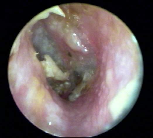 Severe cases IV antibiotics and debridement Otitis externa swimmers ear Otitis media middle ear infection Common in preschool and school age children Eustachian tube development Bacteria from mouth
