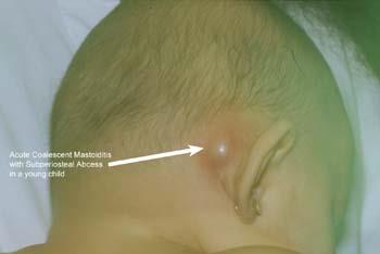 most noticeable with otorrhea o Mimics severe supurative otitis media DX o Dx by