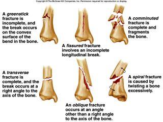 Clinical Application Types of Fractures green