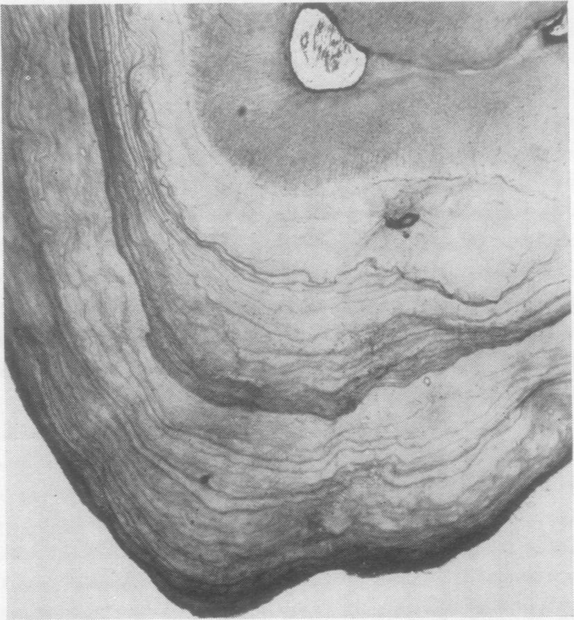 Stafne and Austin (1938) showed that hypercementosis of the teeth is a characteristic finding in Paget's disease, and many.
